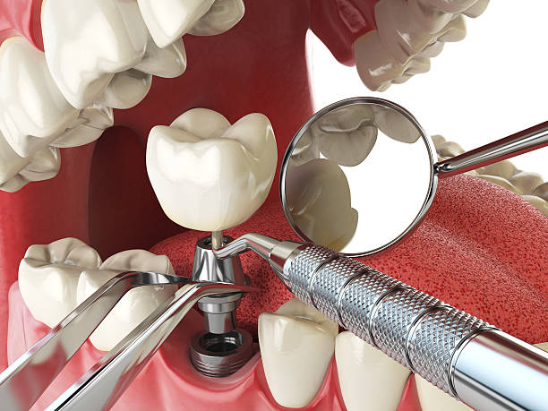 Best Dental Abscess Treatment in Fuller Heights, FL